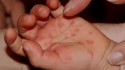 BÀI TUYÊN TRUYỀN PHÒNG BỆNH TAY CHÂN MIỆNG