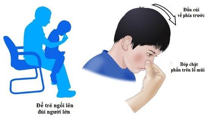 Nguyên nhân gây chảy máu cam ở trẻ nhỏ