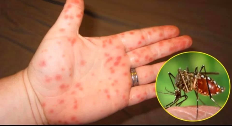 Hà Nội: 4 ca tử vong vì sốt xuất huyết, ghi nhận thêm chủng virus mới